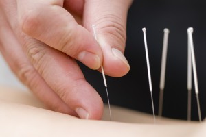 Akupunkturnåle sættes i huden