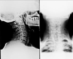Røntgen fotos af hals og rygrad